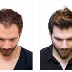 Why You Should Get a Hair Transplant