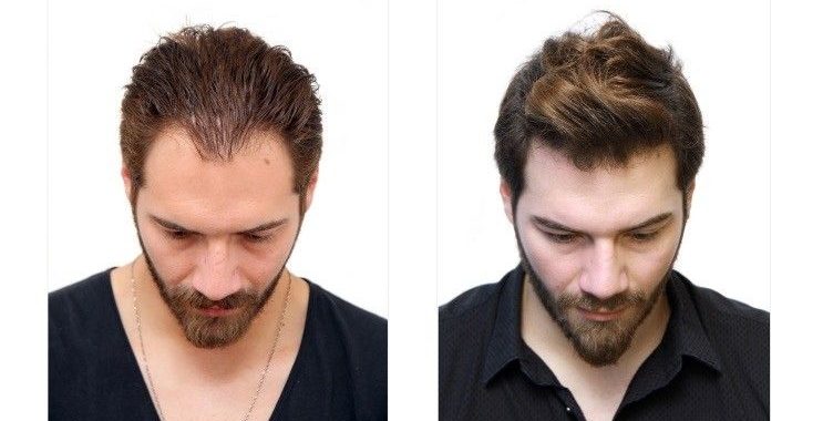 Why You Should Get a Hair Transplant