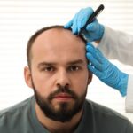 Hair Transplant In Turkey