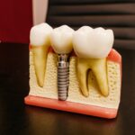 Can It Be Really Cheaper To Get Dental Implants Overseas In 2023