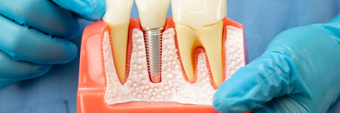 Which usually Country Abroad Should You Choose to Have Teeth Implants?