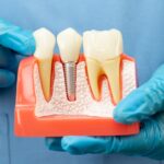 Which usually Country Abroad Should You Choose to Have Teeth Implants?