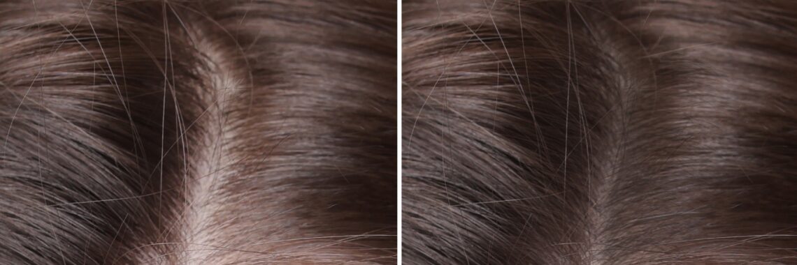 Female Hair Transplant In Turkey