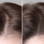 Female Hair Transplant In Turkey